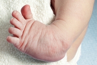 Definitions and Varied Classifications of Clubfoot